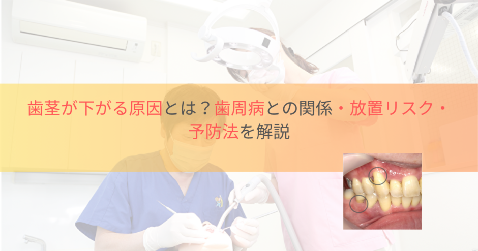 歯茎が下がる原因とは？歯周病との関係・放置リスク・予防法を解説のアイキャッチ画像