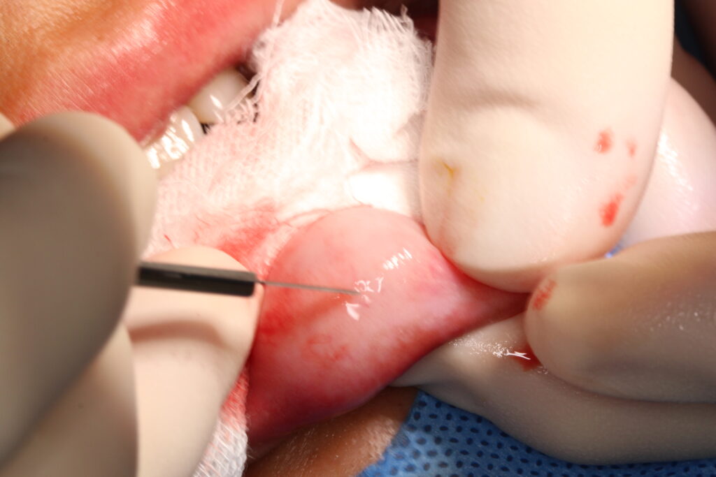 粘液嚢胞手術の写真