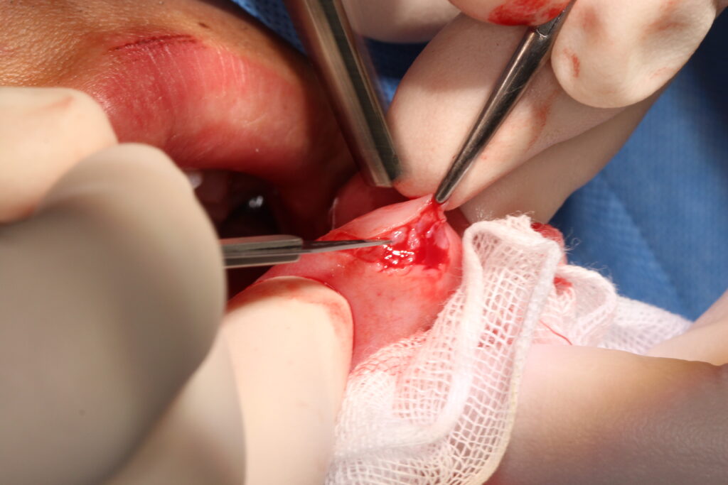 粘液嚢胞の摘出手術の写真