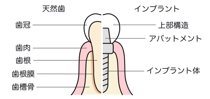 インプラントと天然歯の違いについてのイラスト