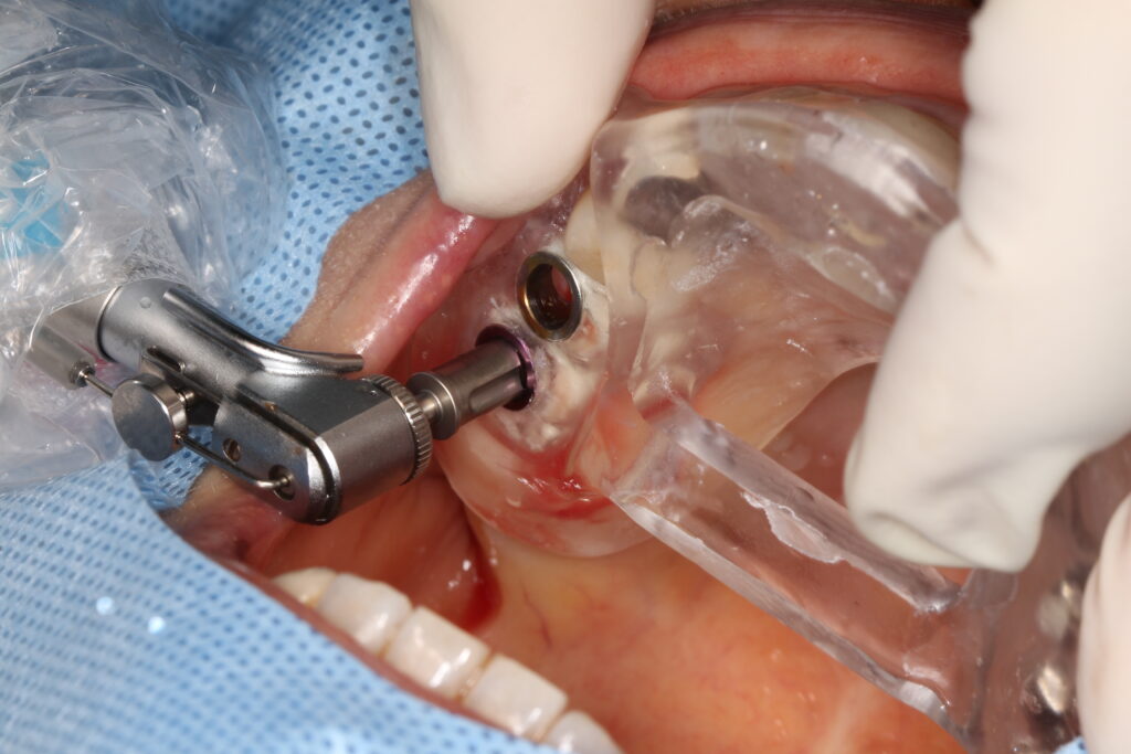 ガイドシステムを用いたインプラント手術の写真