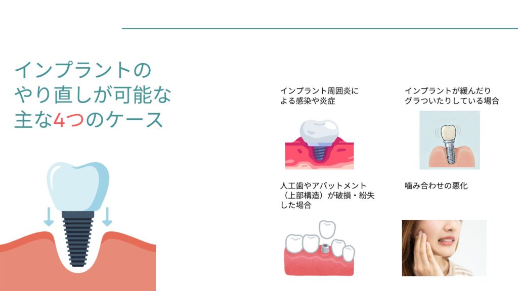 インプラントの
やり直しが可能な
主な4つのケースのサムネイル