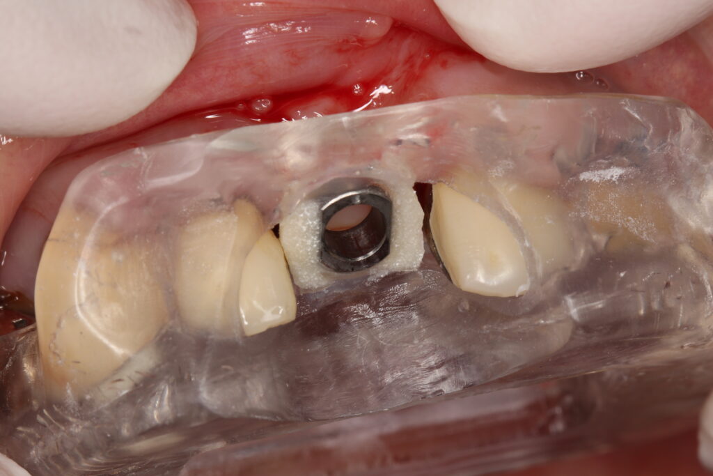 サージカルガイド