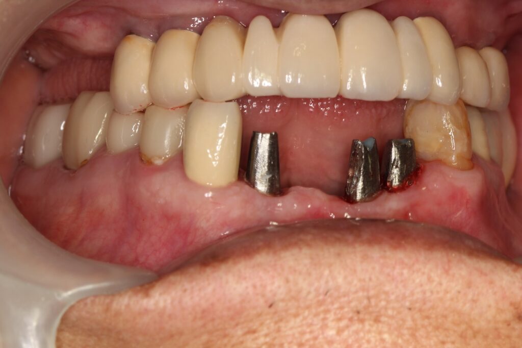 前歯部インプラントアバットメント装着時の写真