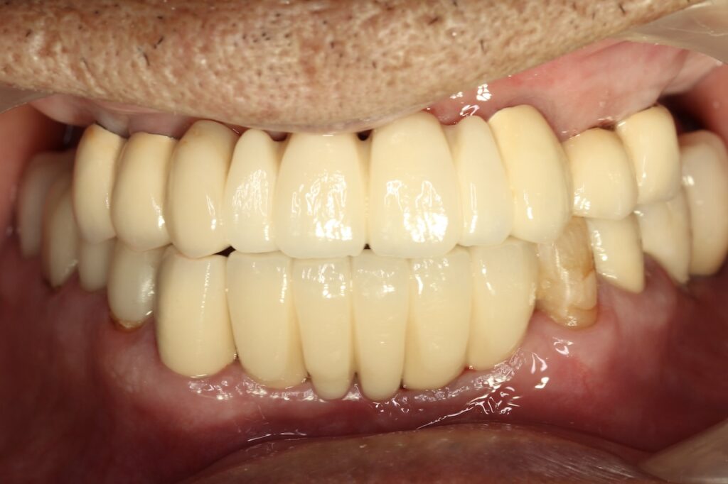 インプラント前歯部上部構造装着時の写真