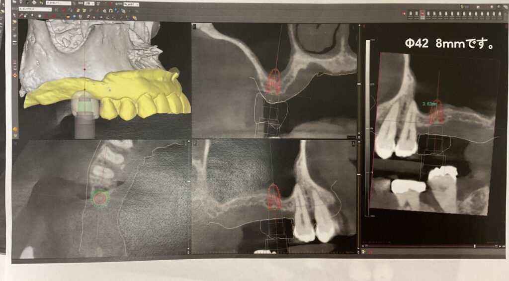 インプラント計画中の患者様のCT画像