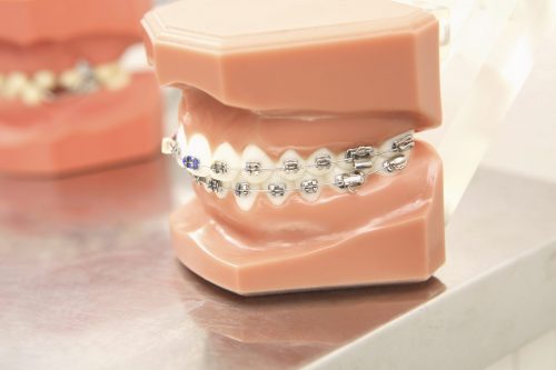 歯科矯正装置を付けている歯科模型の写真